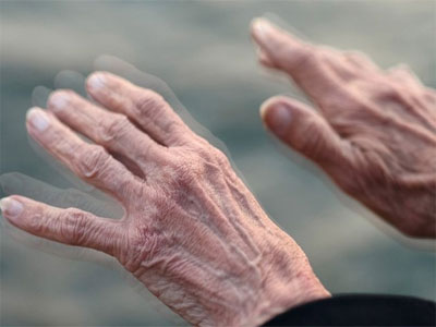 La Asociacin de Parkinson hace balance positivo tras los diez meses de su creacin