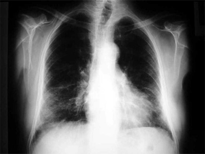 La universidad y el Hospital Torrecrdenas definen el escenario cientfico actual en torno a la tuberculosis 